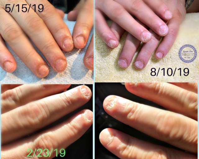 IBX Treatments