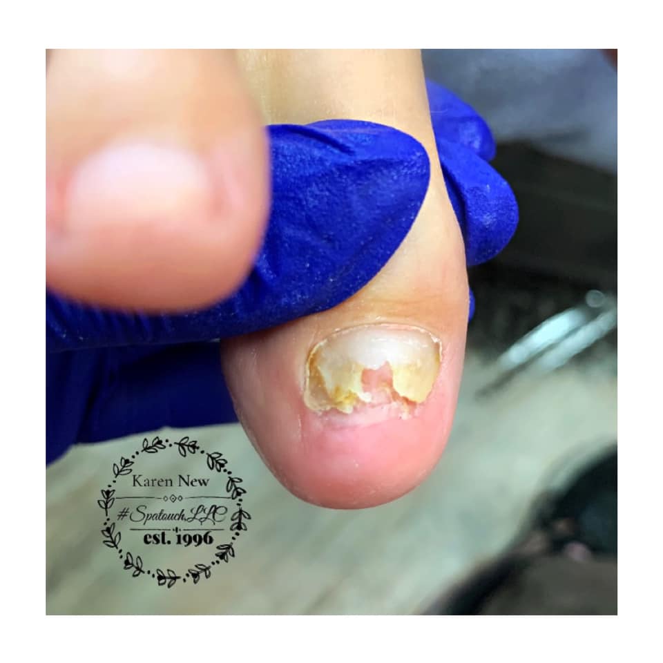 Cracked Nails